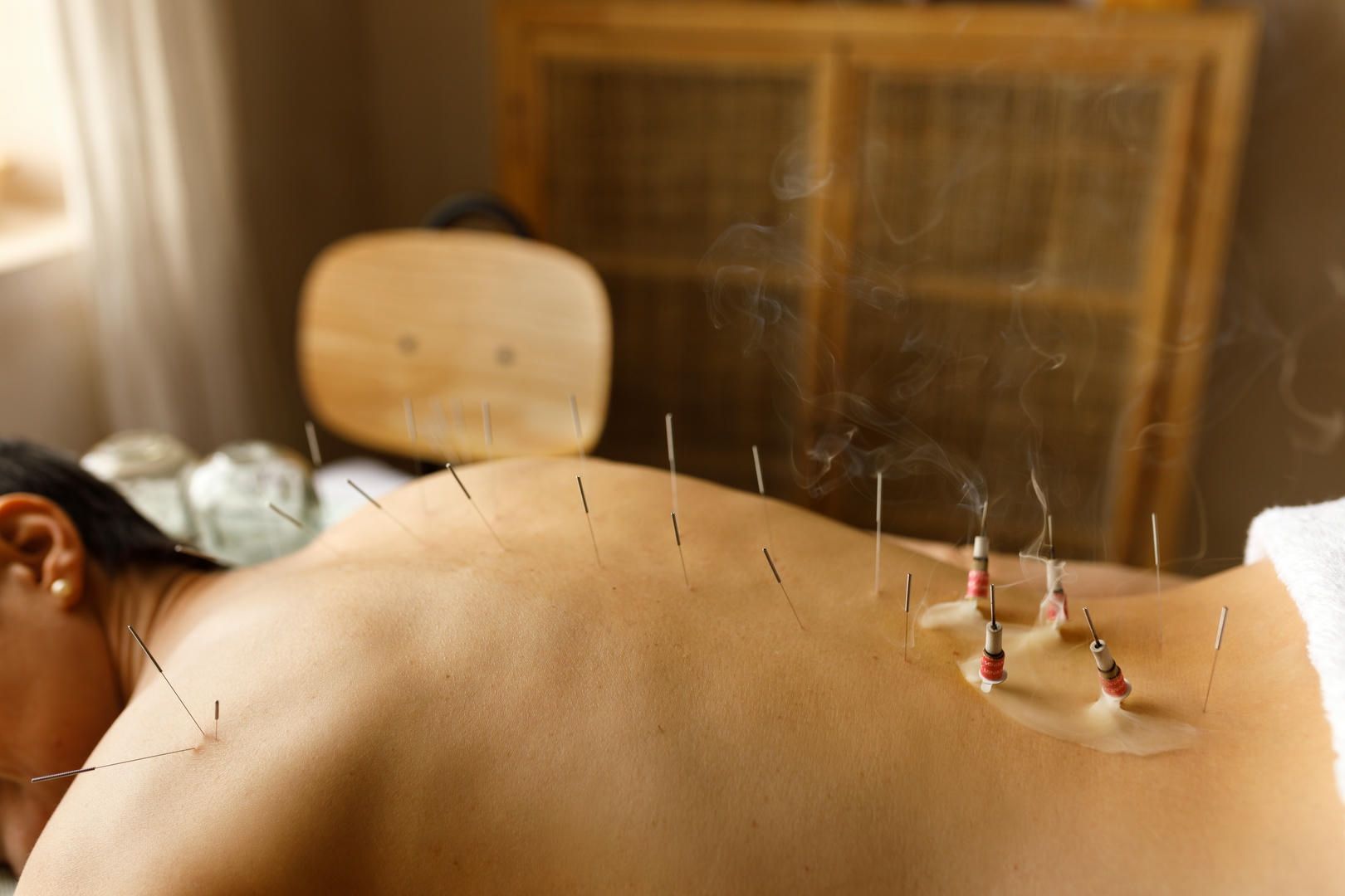 A woman is getting acupuncture on her back.