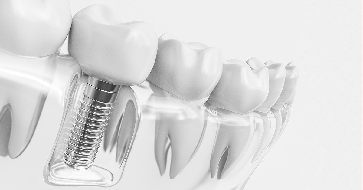  dental implant longevity
