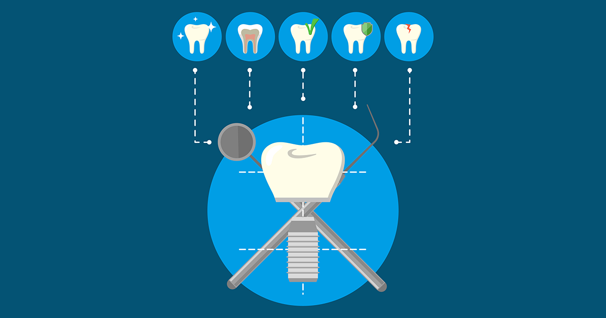 Dental Implants, Dentist in Laurel MD