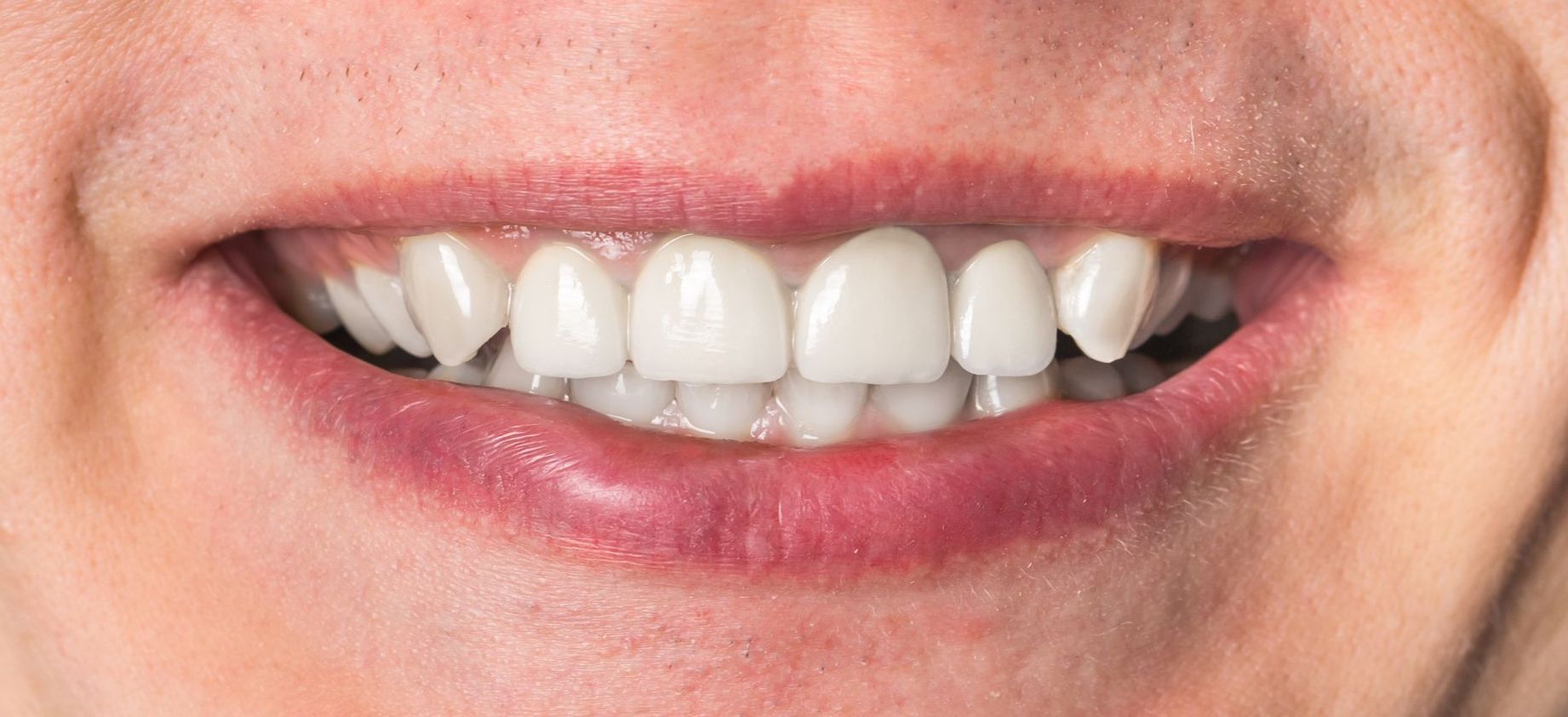 After Dental Implants