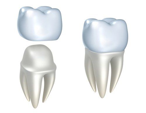 illustration of dental how dental crowns cover the tooth