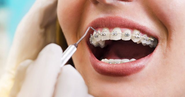Invisalign v Braces – How to decide which is right for you