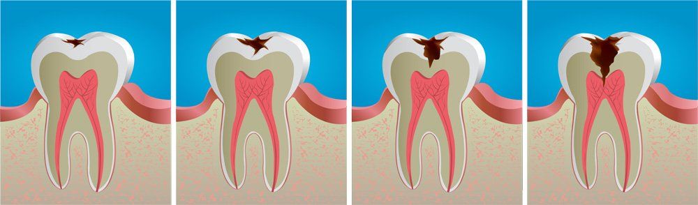 illustrated stages of a cavity forming in a tooth