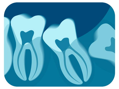 illustration of wisdom tooth growing incorrectly