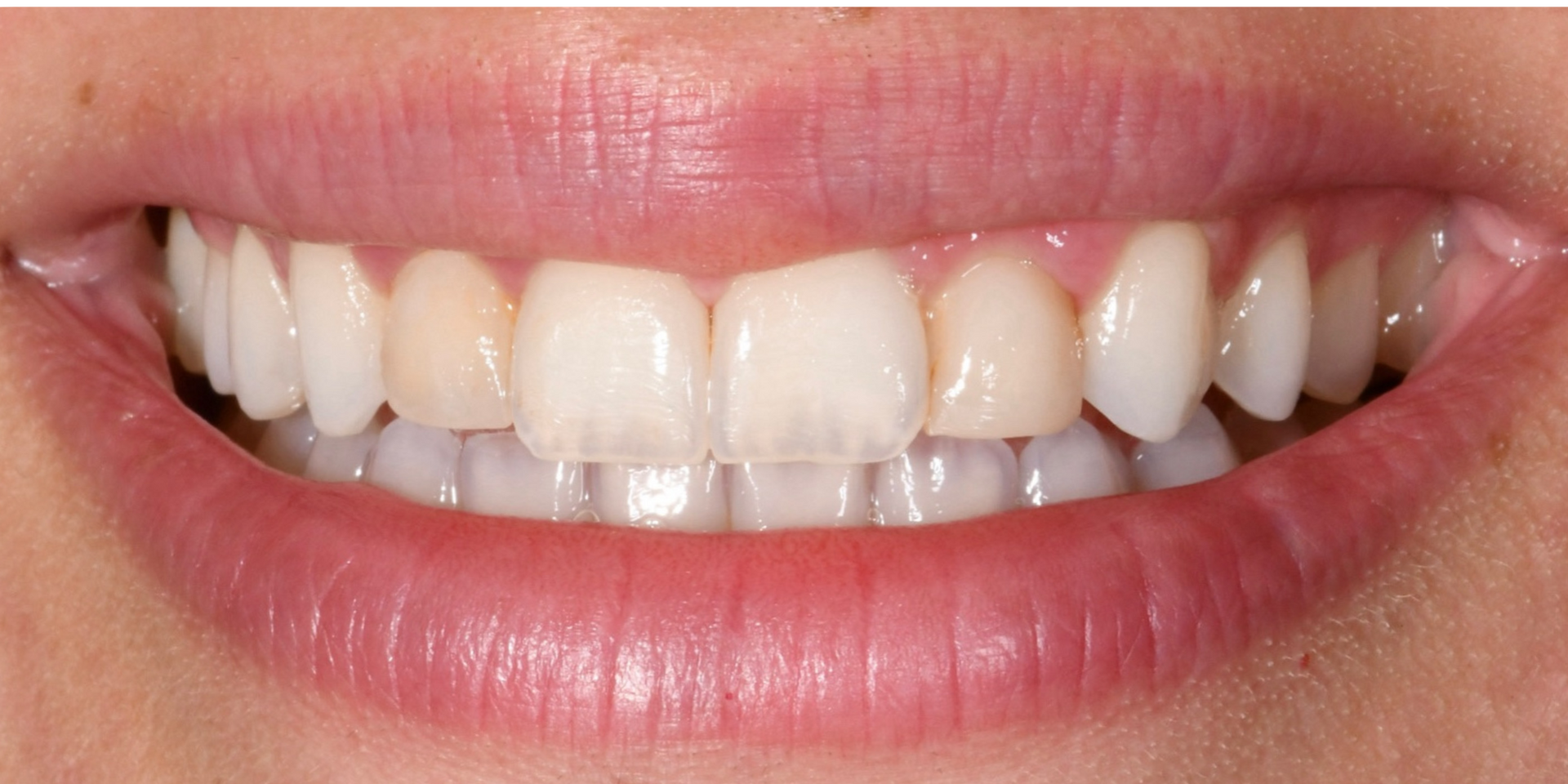 Smile before dental veneers in Dearborn and Birmingham 