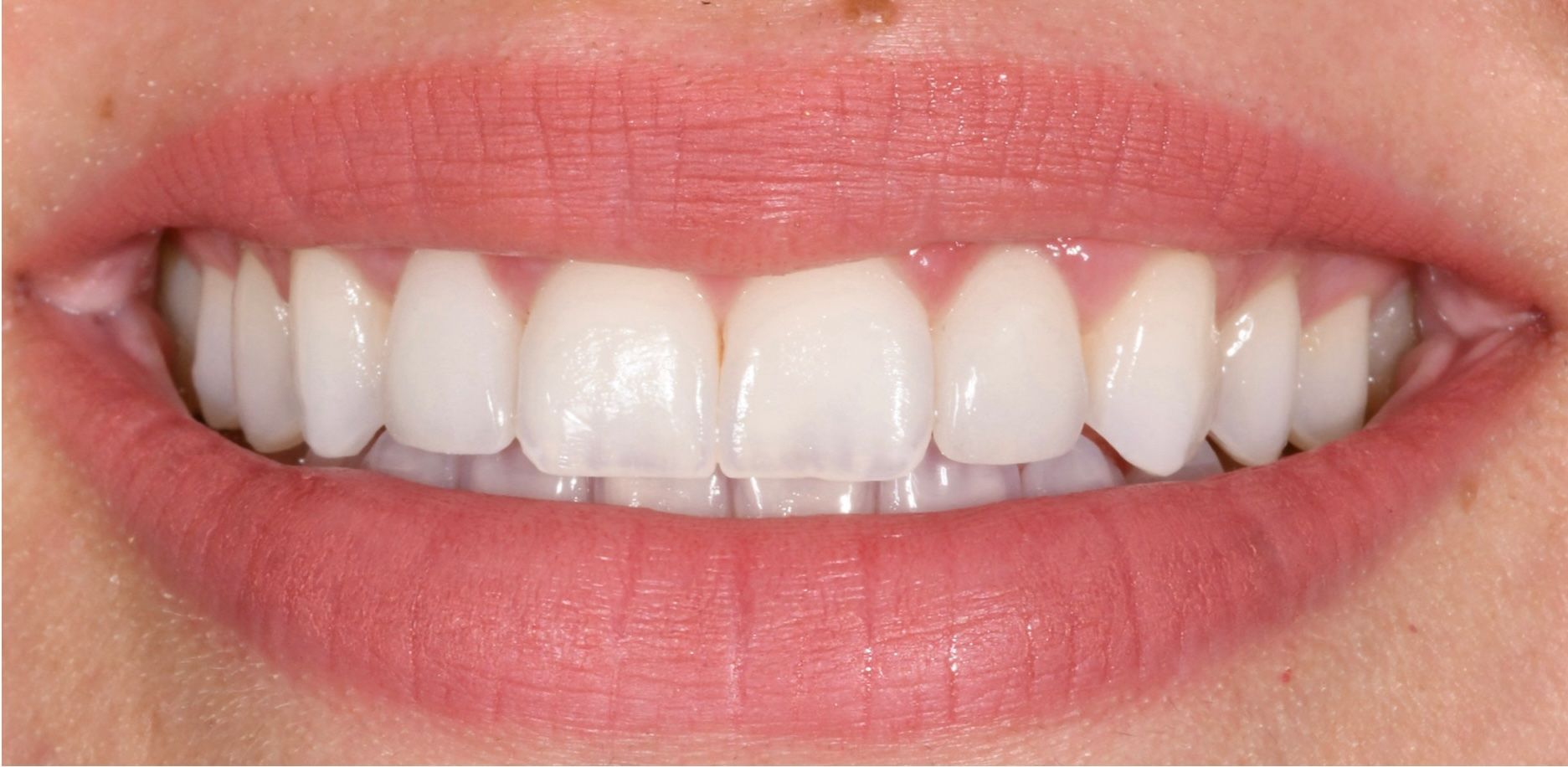 Teeth after getting dental veneers in Birmingham 48009