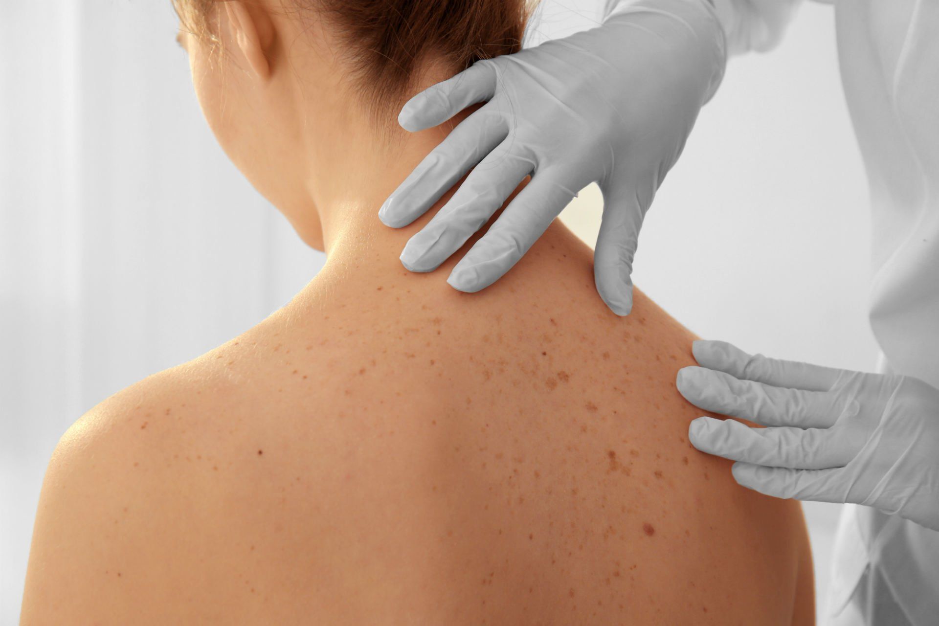 Dermatologo esamina nei sulla schiena di una donna
