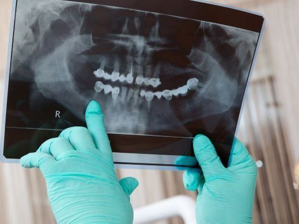 Dental x-ray