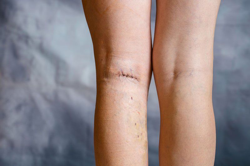 Leg after varicose vein surgery.