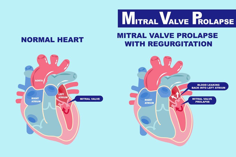 mitral valve prolapse symptoms