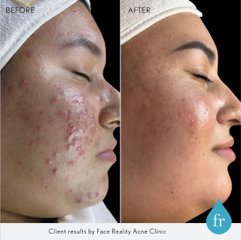 A before and after photo of a woman 's face with acne