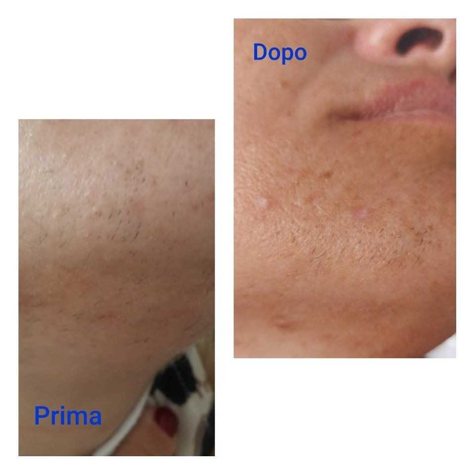 prima e dopo trattamento viso