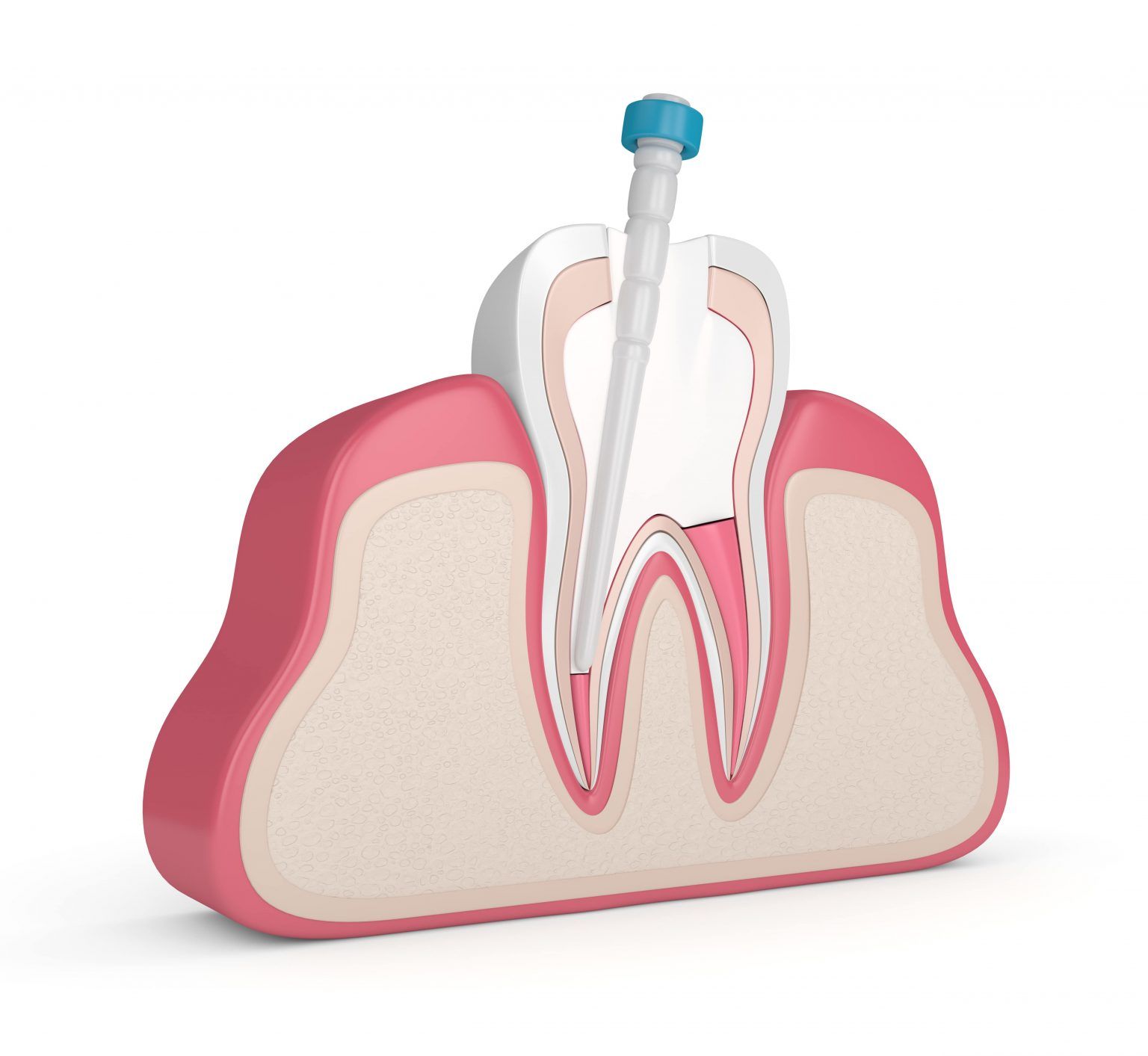 root canal process