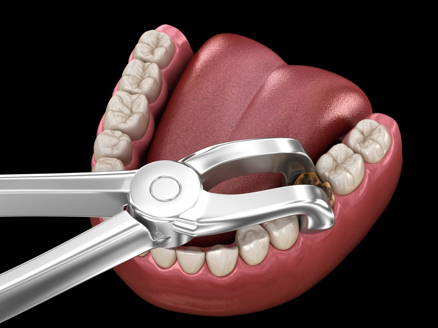 tooth extraction