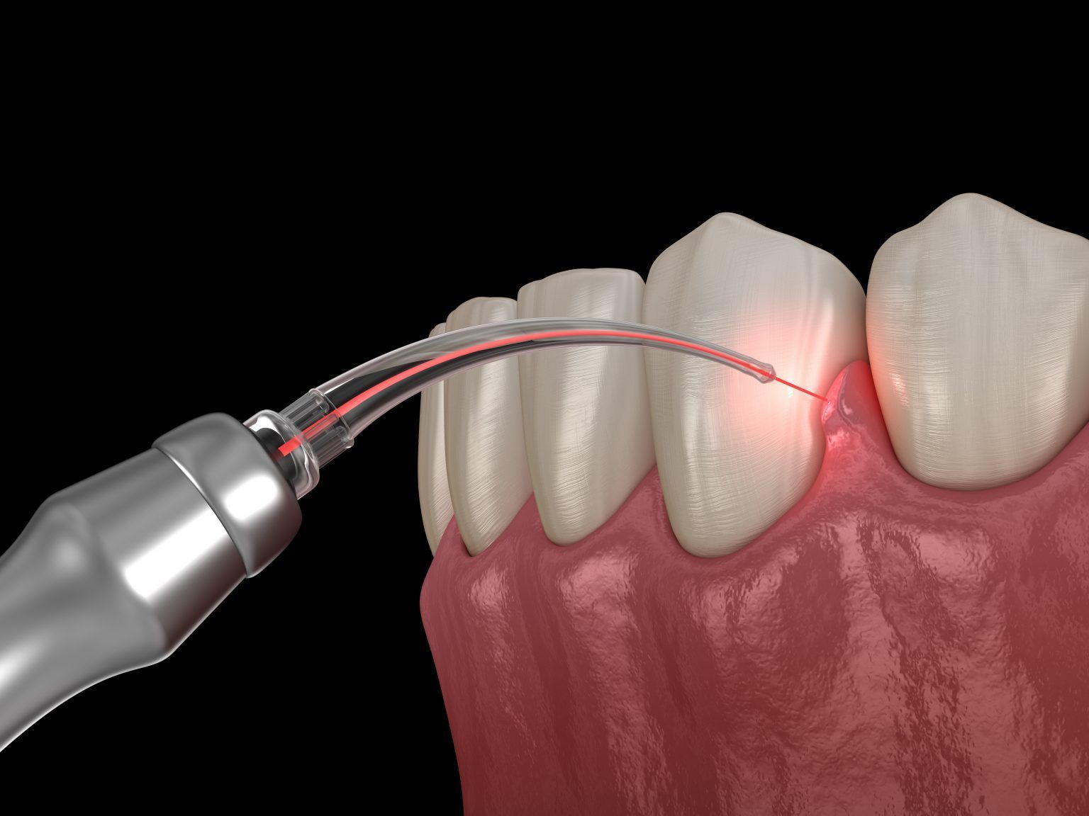 dental laser