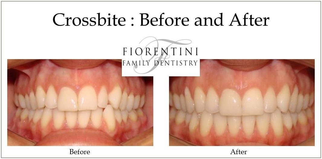 Crossbite before and after | Best dentists in Highland Park and Monroe Township NJ 