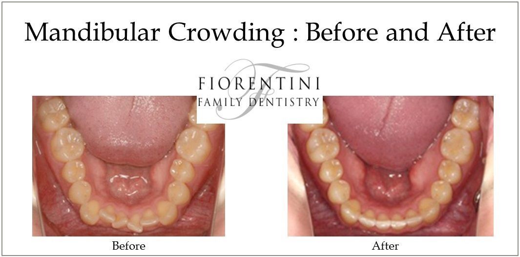 INVISALIGN before and after | Best dentists in Highland Park and Monroe Township NJ 