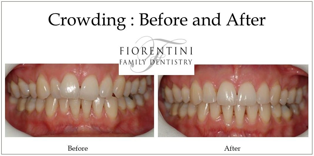INVISALIGN fixing crowded mouth | before and after | Monroe and Highland Park NJ 