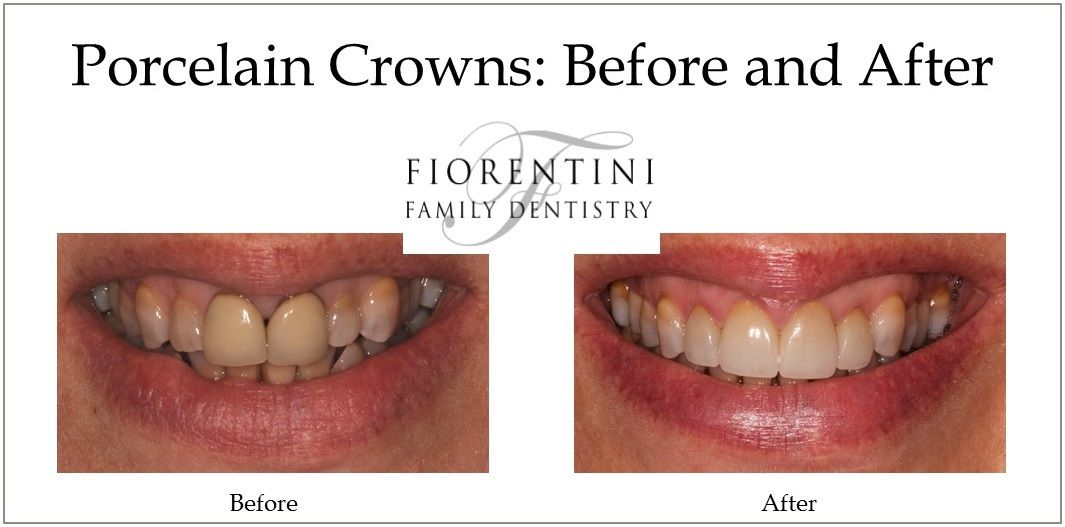 Before and after photo of dental crowns done at our top rated dental practice in Monroe and Highland Park NJ