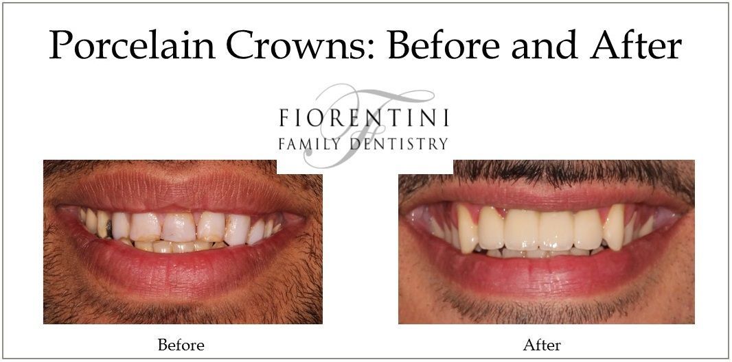 before and after photo of dental crowns done by our family dentists in Monroe and Highland Park NJ