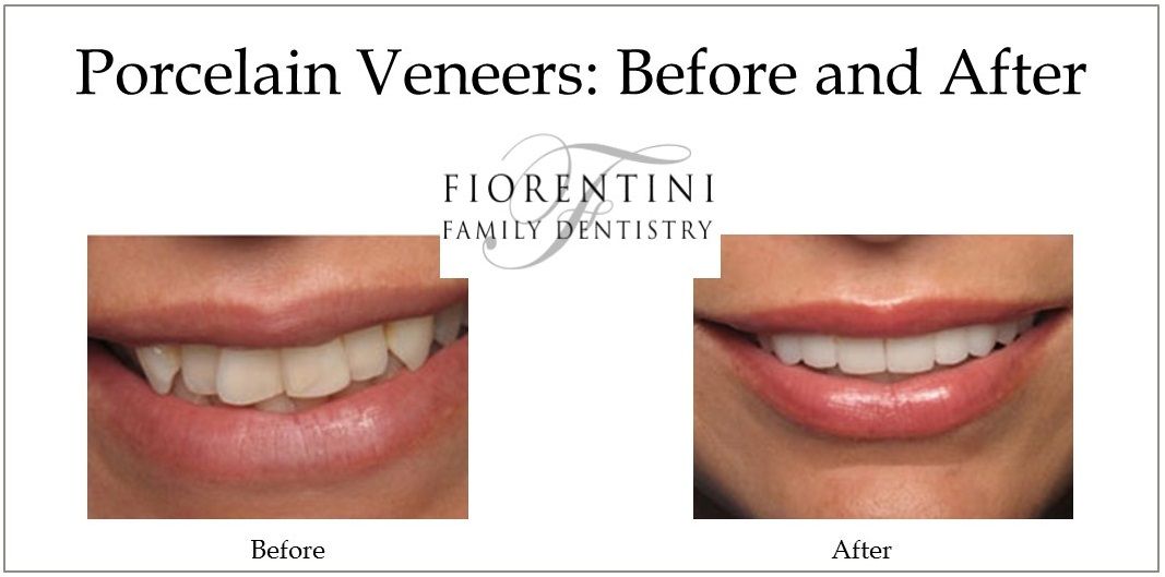 Before and After Photo of Veneers | Top dentists in Monroe and Highland Park NJ