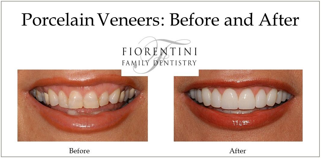 Before and after photo of veneers done at our top rated dental practice in Monroe and Highland Park NJ