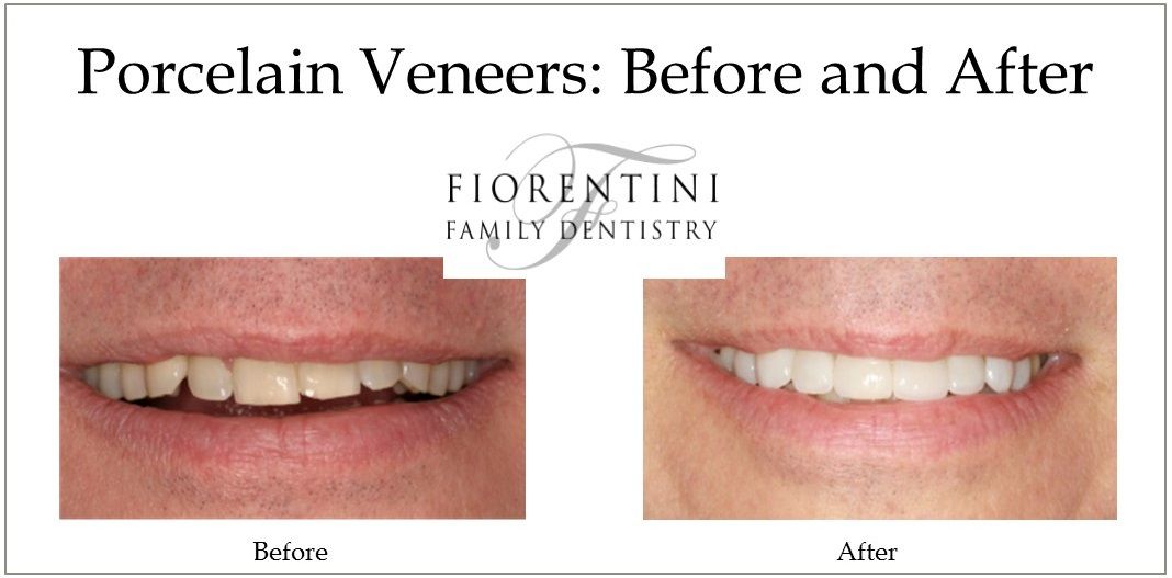 Before and after photo of veneers done at our top rated dental practice in Monroe and Highland Park NJ