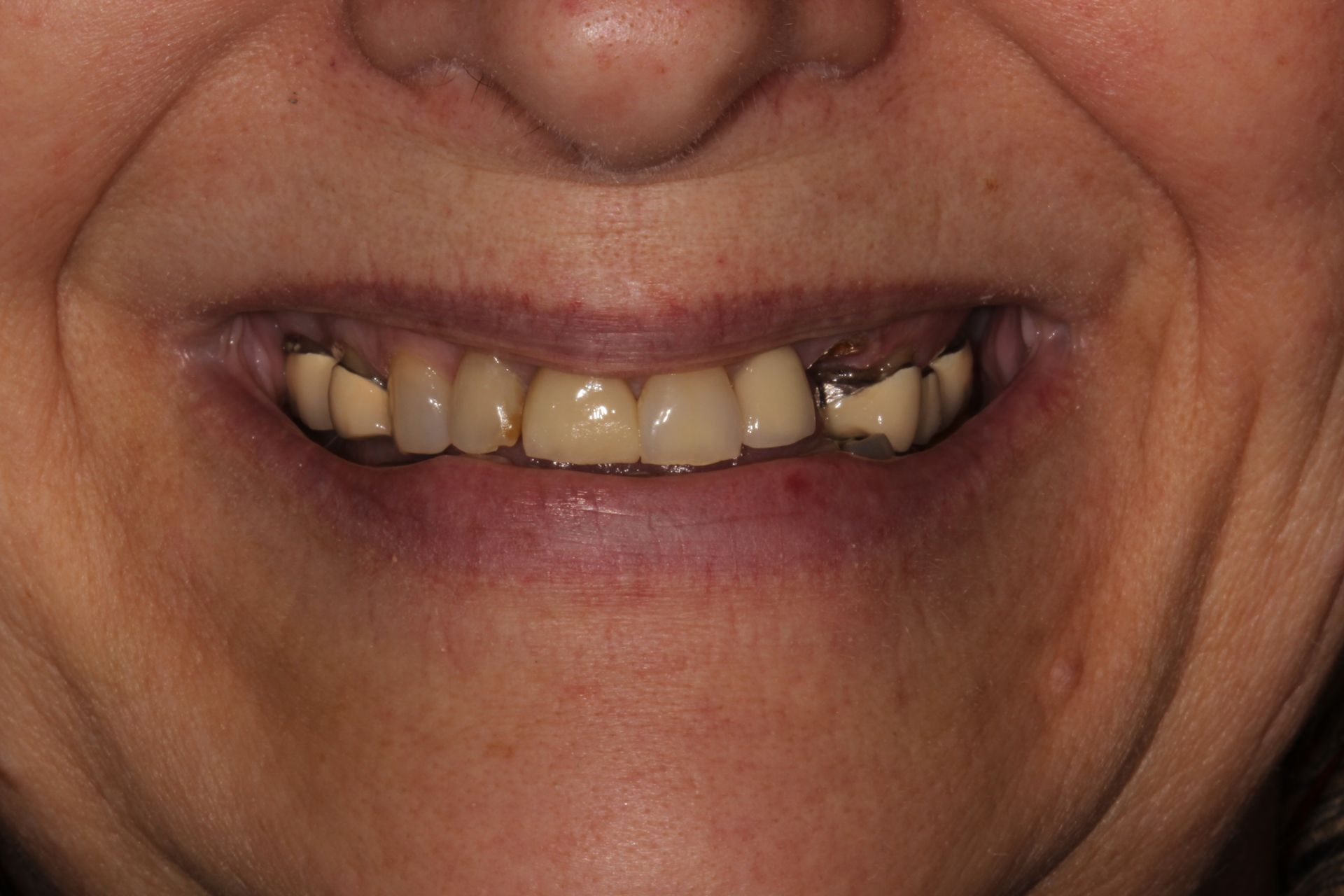 before dental veneers/crowns | dentists in Highland and Monroe NJ