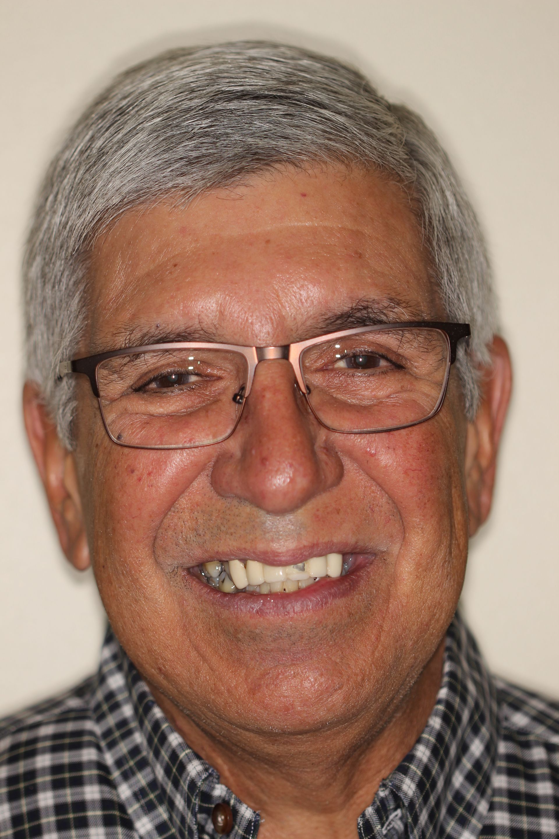 MAXILLARY FIXED HYBRID 4