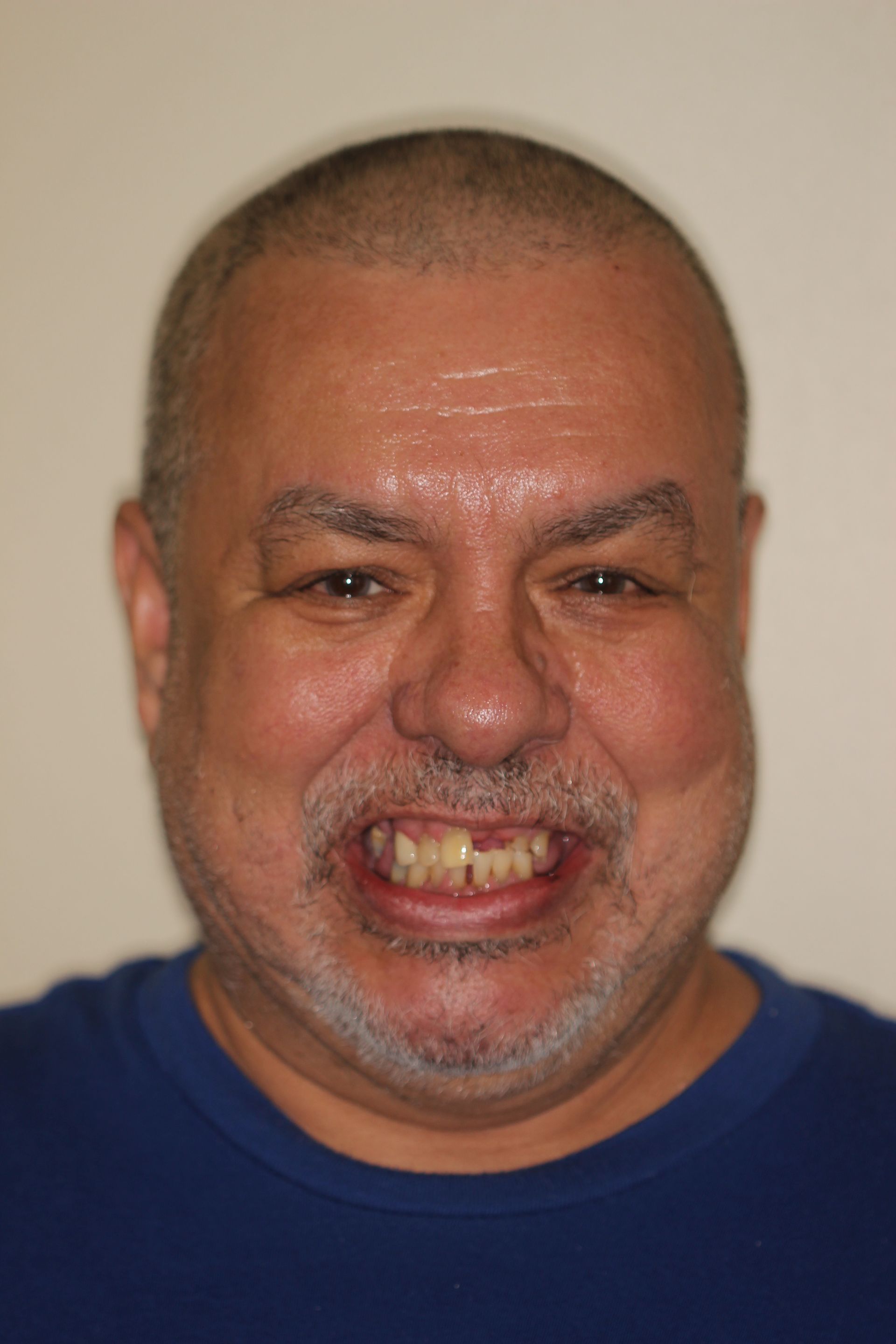 man with missing teeth | Before dental veneers and crowns | Monroe 08831