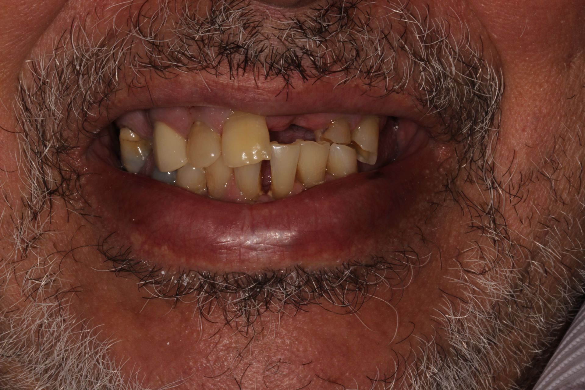 MAXILLARY FIXED HYBRID 3