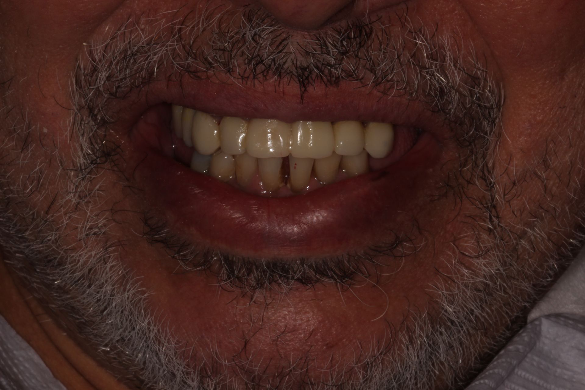 MAXILLARY FIXED HYBRID 3