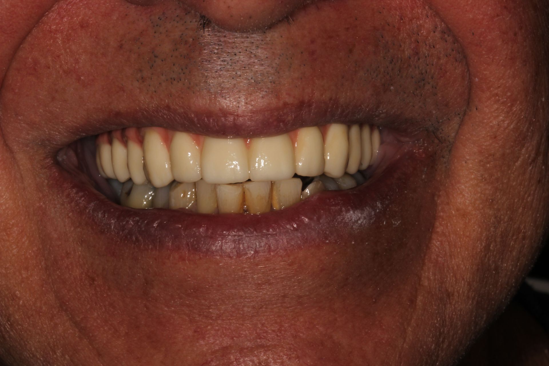 before dental fillings and crowns by our highland park nj dentist