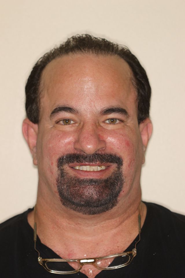 MAXILLARY FIXED HYBRID 3