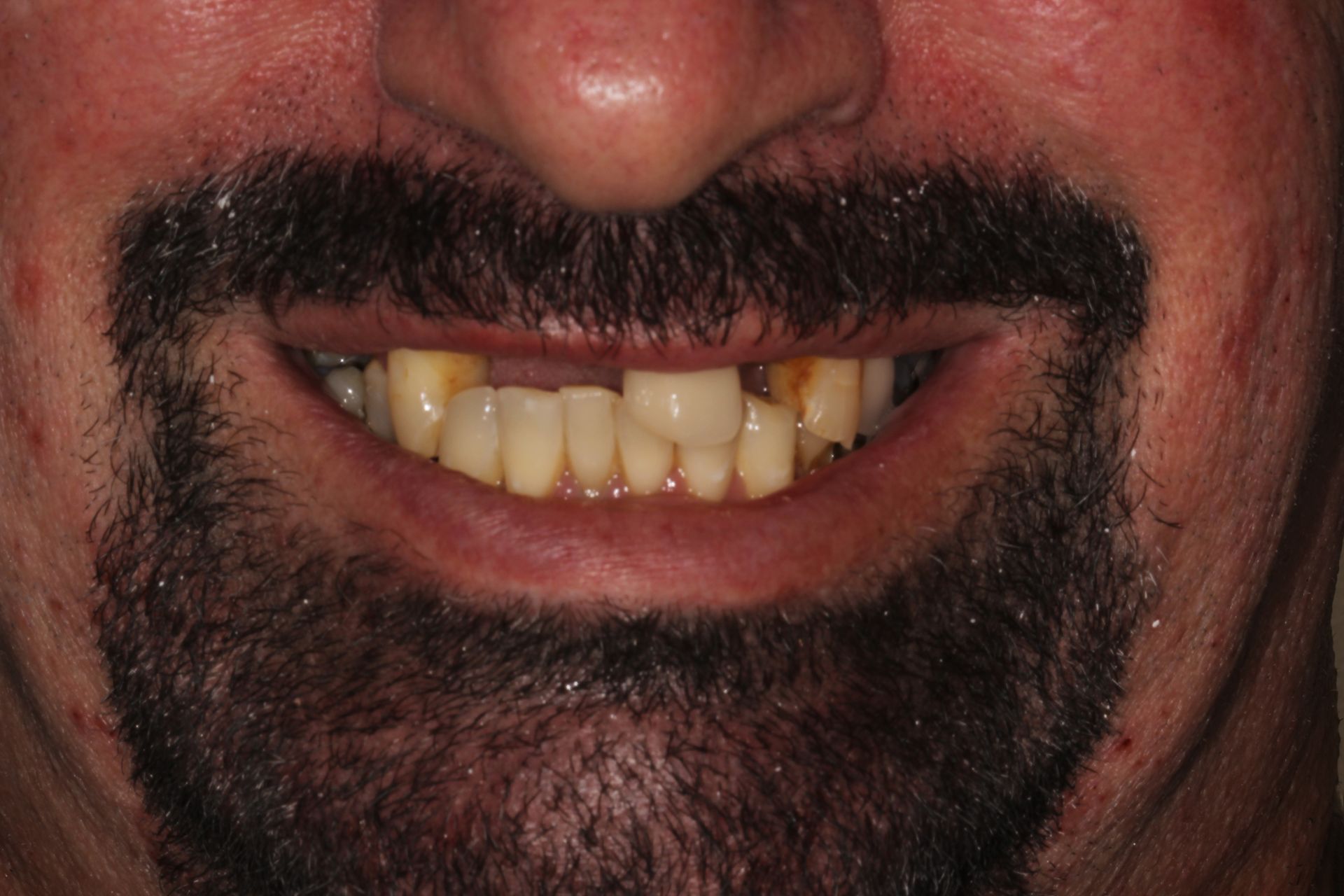 man smiling with damages, rotten teeth | before veneers and root canals in highland park nj