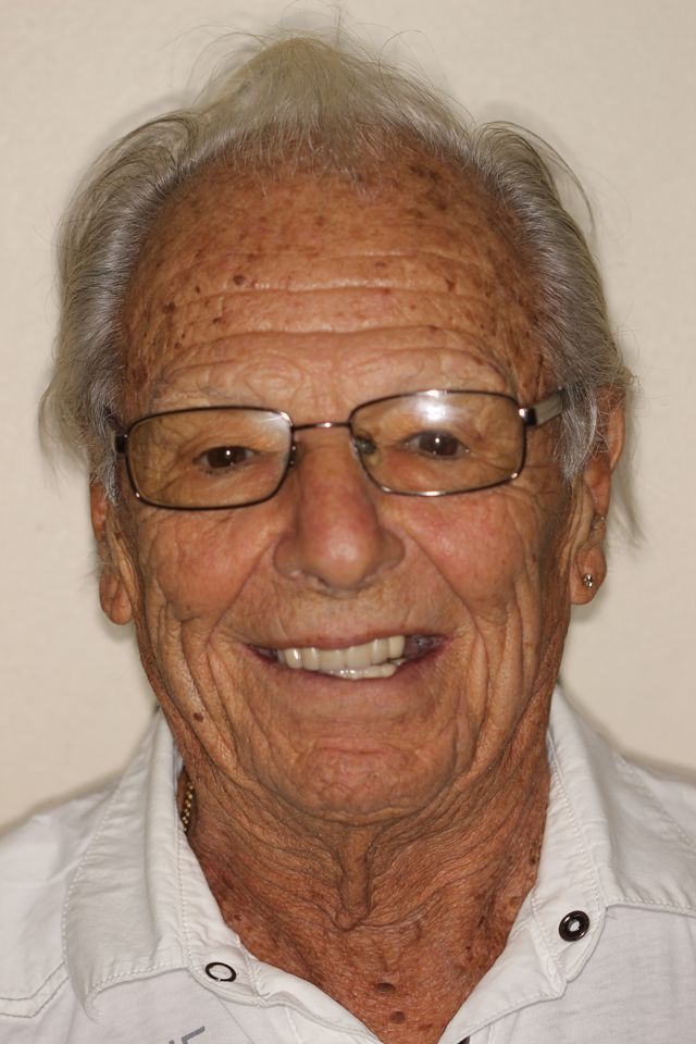 MAXILLARY FIXED HYBRID 3