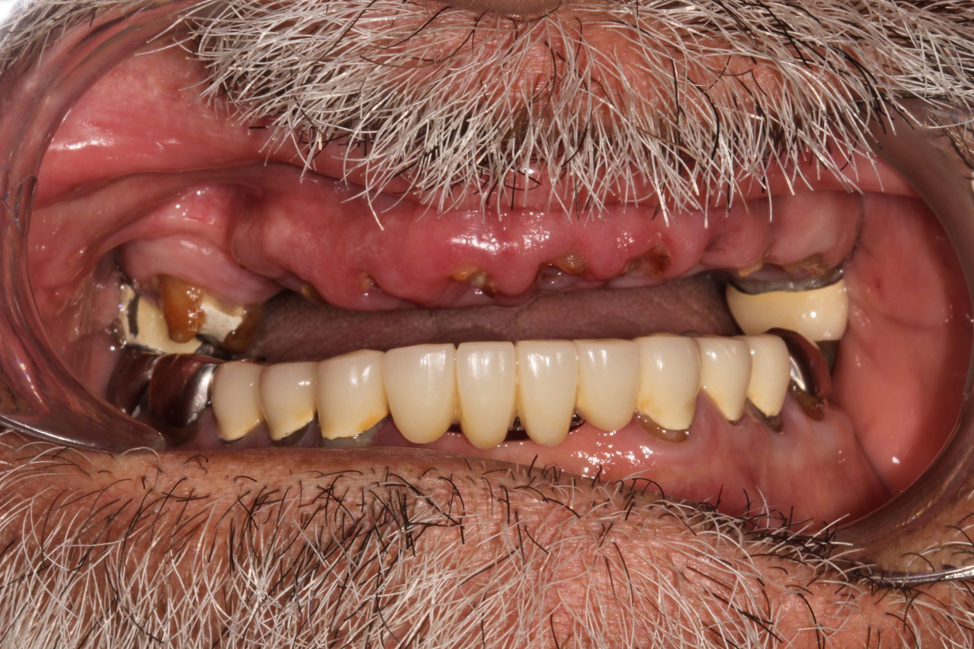 after tooth removal for dentures and implants in Monroe township and Highland park nj