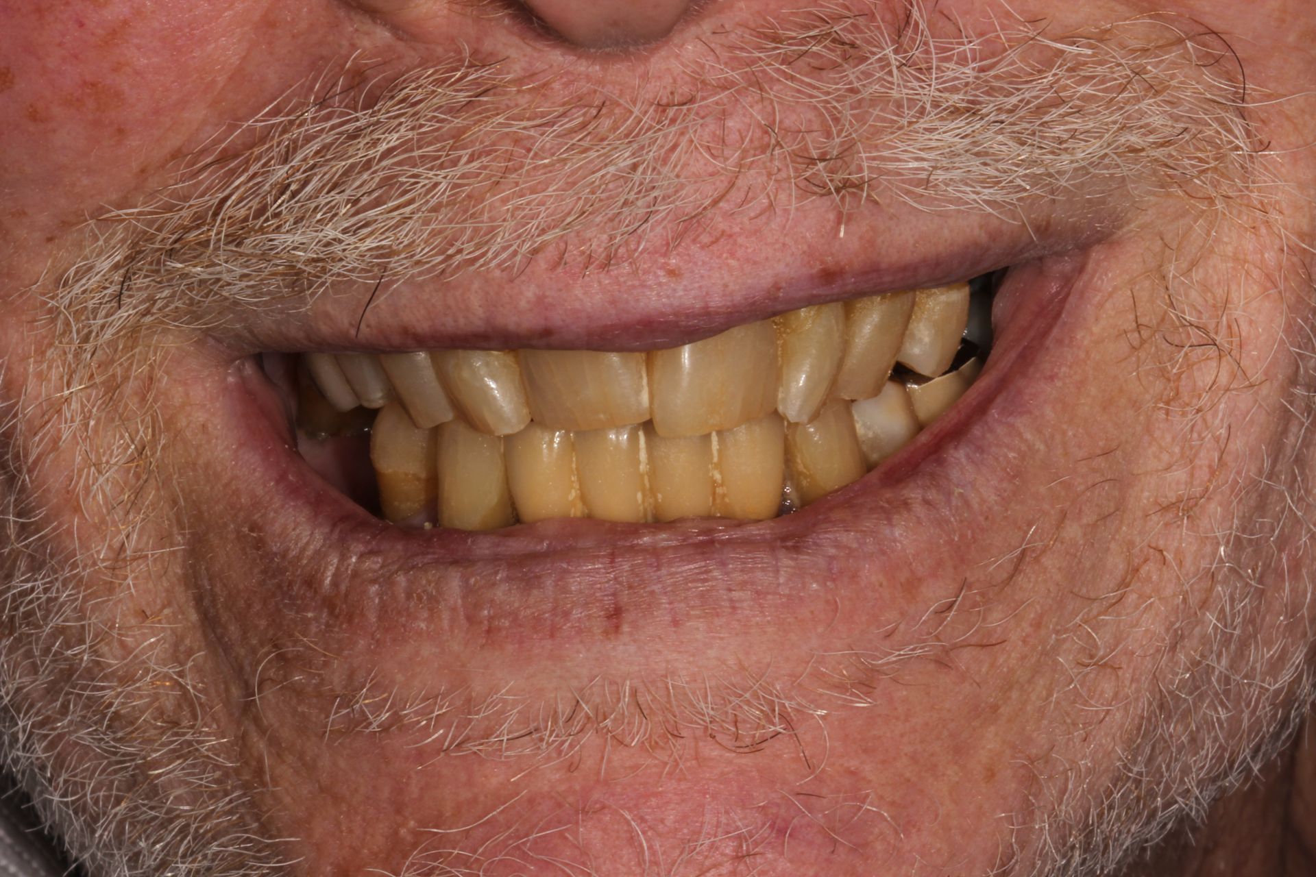 yellow teeth | Before dentures and whitening in Monroe township nj