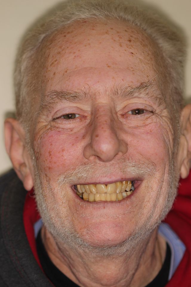 MAXILLARY FIXED HYBRID 5