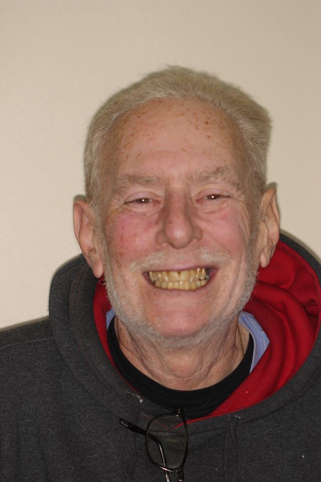 MAXILLARY FIXED HYBRID 5