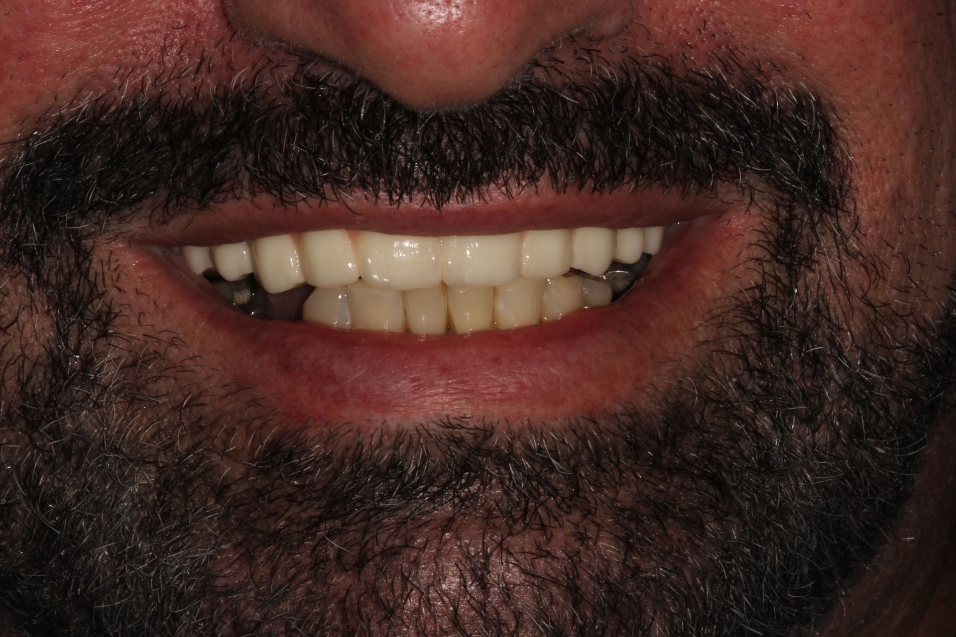 man smiling after dental veneers in highland park nj