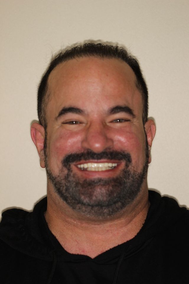 MAXILLARY FIXED HYBRID 3