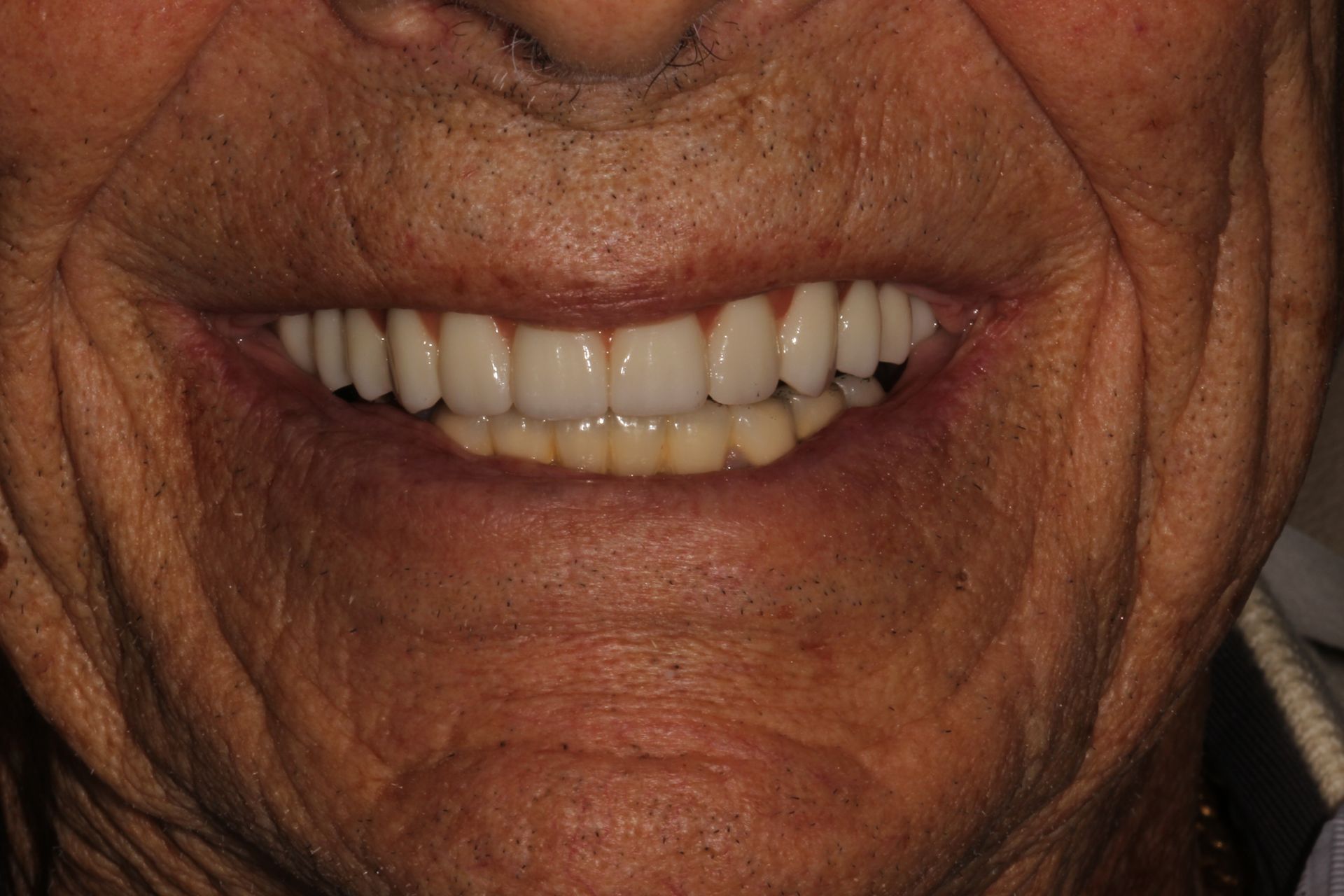 after dental fillings and crowns by our Monroe township nj dentist