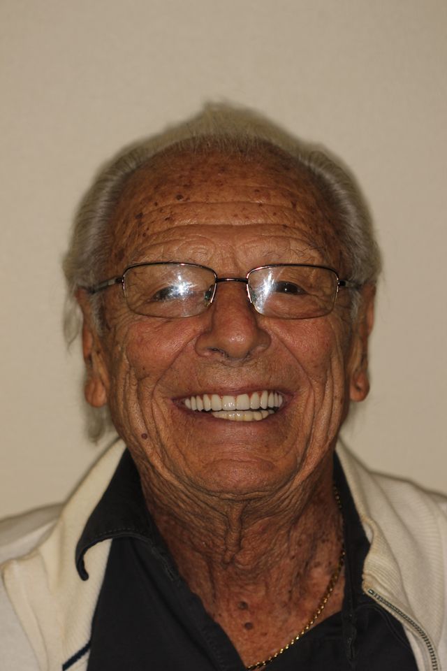 MAXILLARY FIXED HYBRID 3