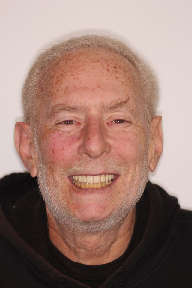 MAXILLARY FIXED HYBRID 5