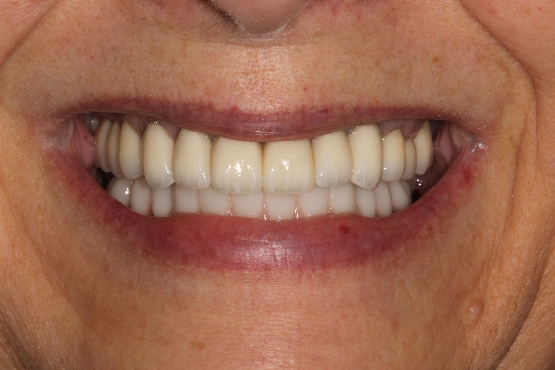 After dental veneers and crowns in Monroe and Highland Park NJ