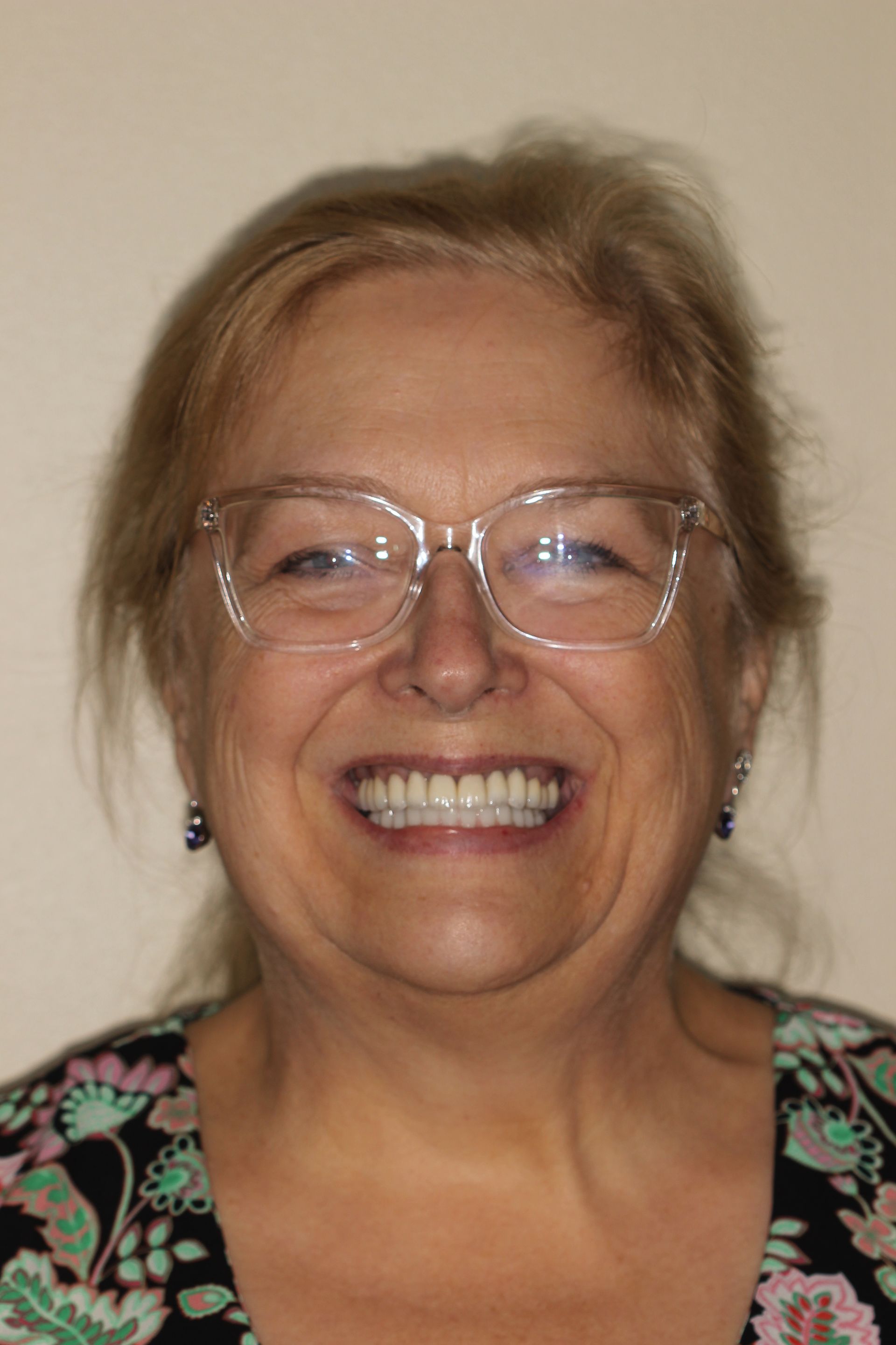 MAXILLARY FIXED HYBRID 3