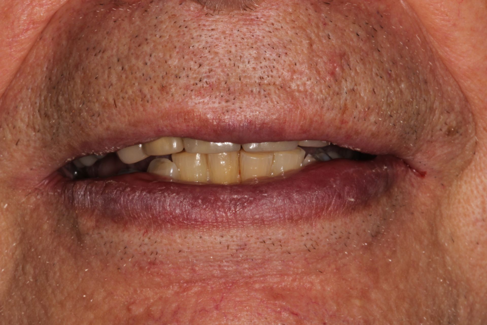 teeth before whitening and dentures in highland park nj