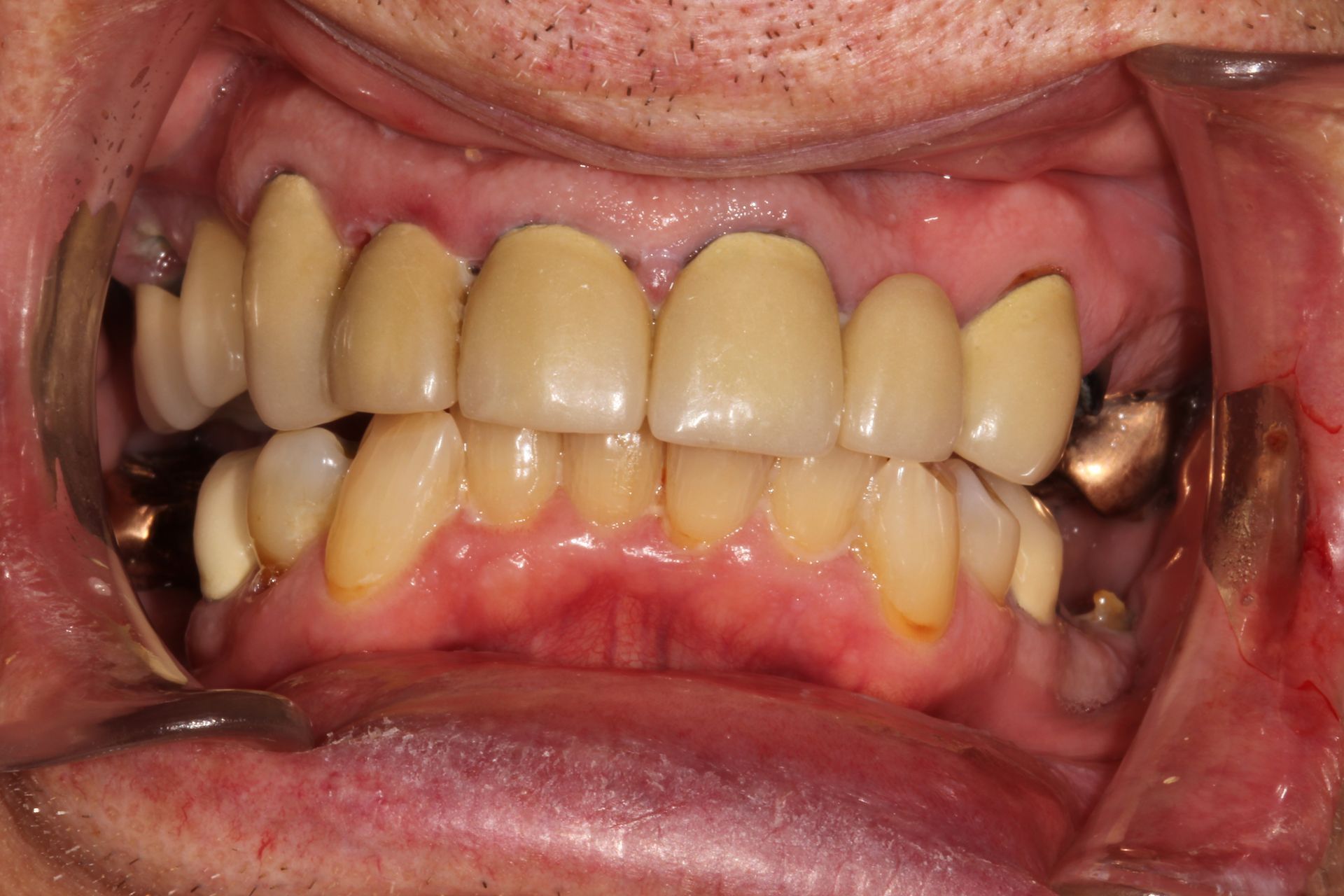 yellow, infected gums and teeth | before dentures and implants | dentist in Monroe township nj