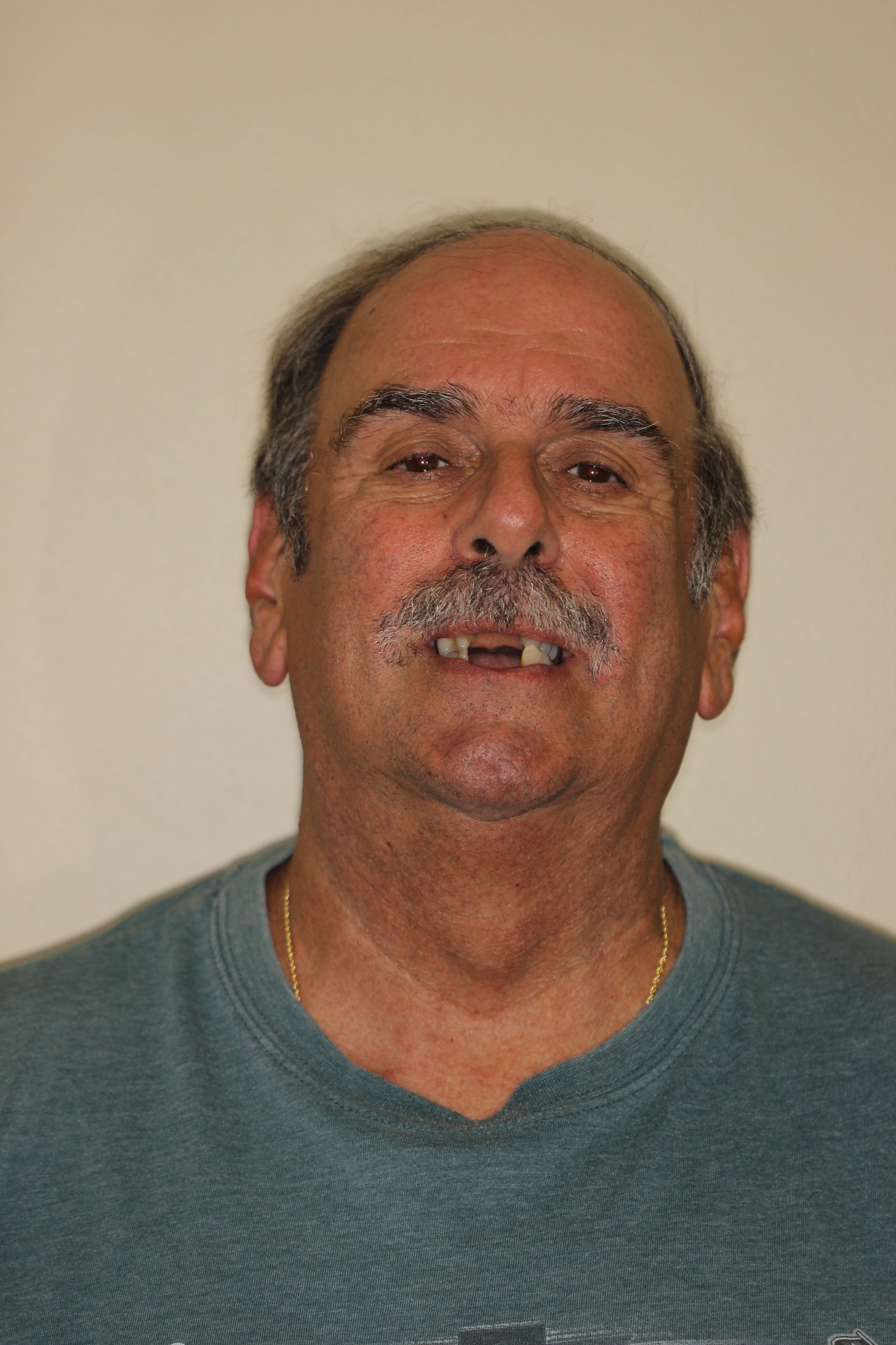 before dental veneers and crowns | Dentists in Monroe and highland park nj 